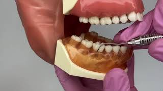 How to use a Nabers Probe