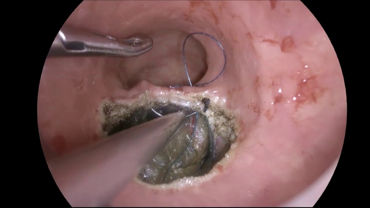 Tamis-Trans Rectal Microinvasive Surgery. - YouTube