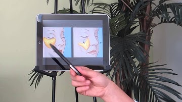 The Aging Process Part II - Volume Loss, by Dr. Waples from Restor Medical Spa