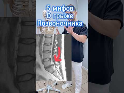 Правда о грыже позвоночника удивит тебя #позвоночник #грыжа #поясница