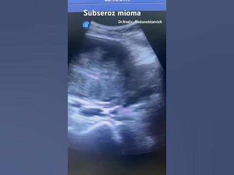 Subseroz mioma. Субсерозная миома тело матки. #utt #ultrasound #matka # ...