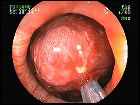 Video: Sigmoid Kolonpolyp: Symptomer, Behandling, Fjerning, årsaker