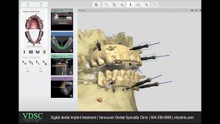 Digital dental implant treatment planning screenshot 5