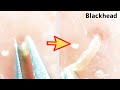 【角栓除去】長っ!!大量のニキビを芯出しするのって気持ちいい/Blackhead Removal Show