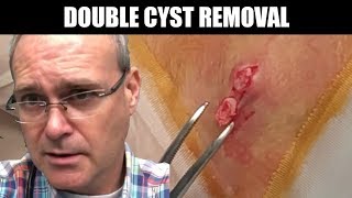 Smash's Pearly White Double Cyst | Dr. John Gilmore