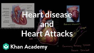 Heart disease and heart attacks | Miscellaneous | Heatlh & Medicine | Khan Academy