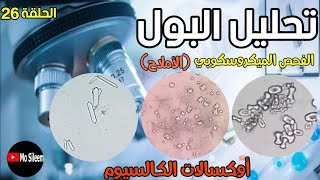 Urinalysis 26 microscopic ex crystals (Calcium oxalate)