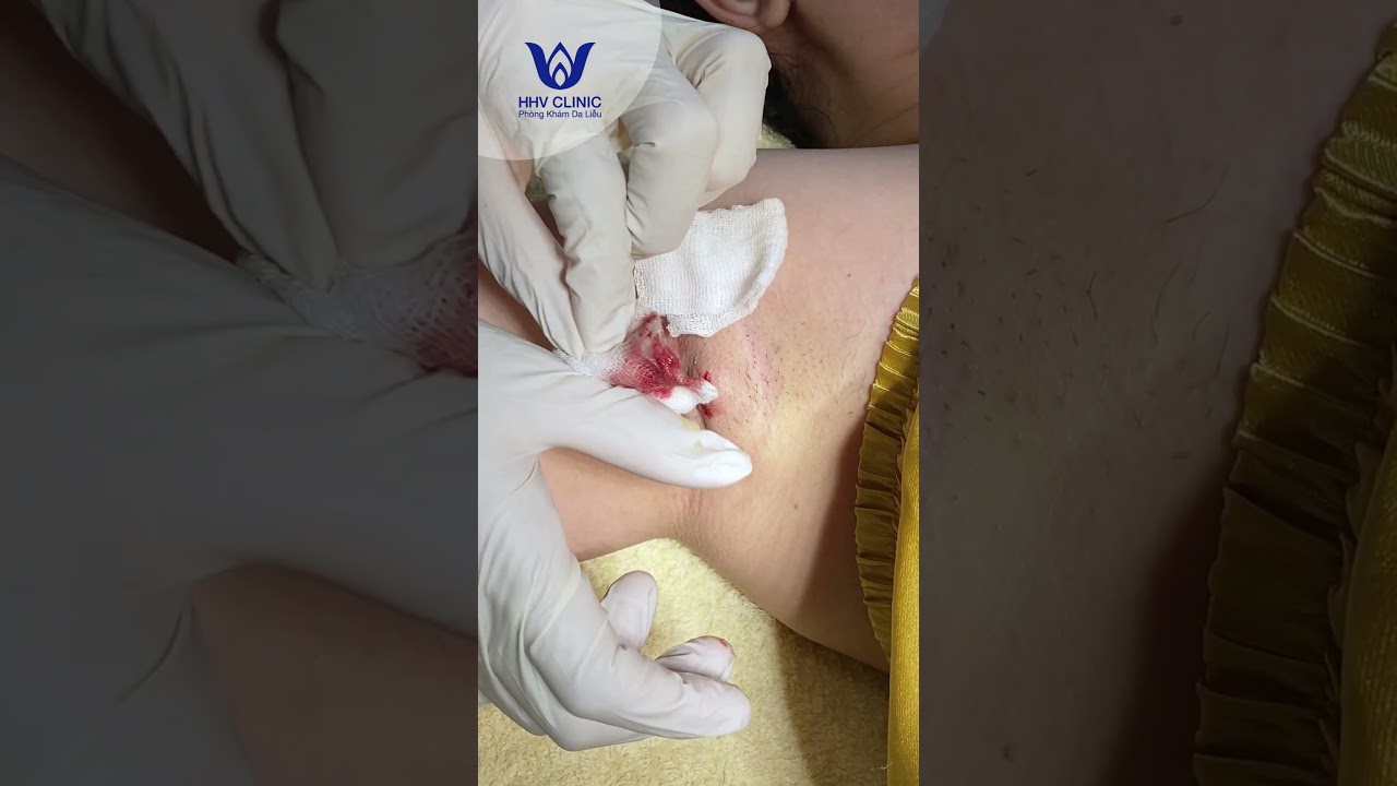 Nặn mụn áp xe sưng viêm to ở nách.