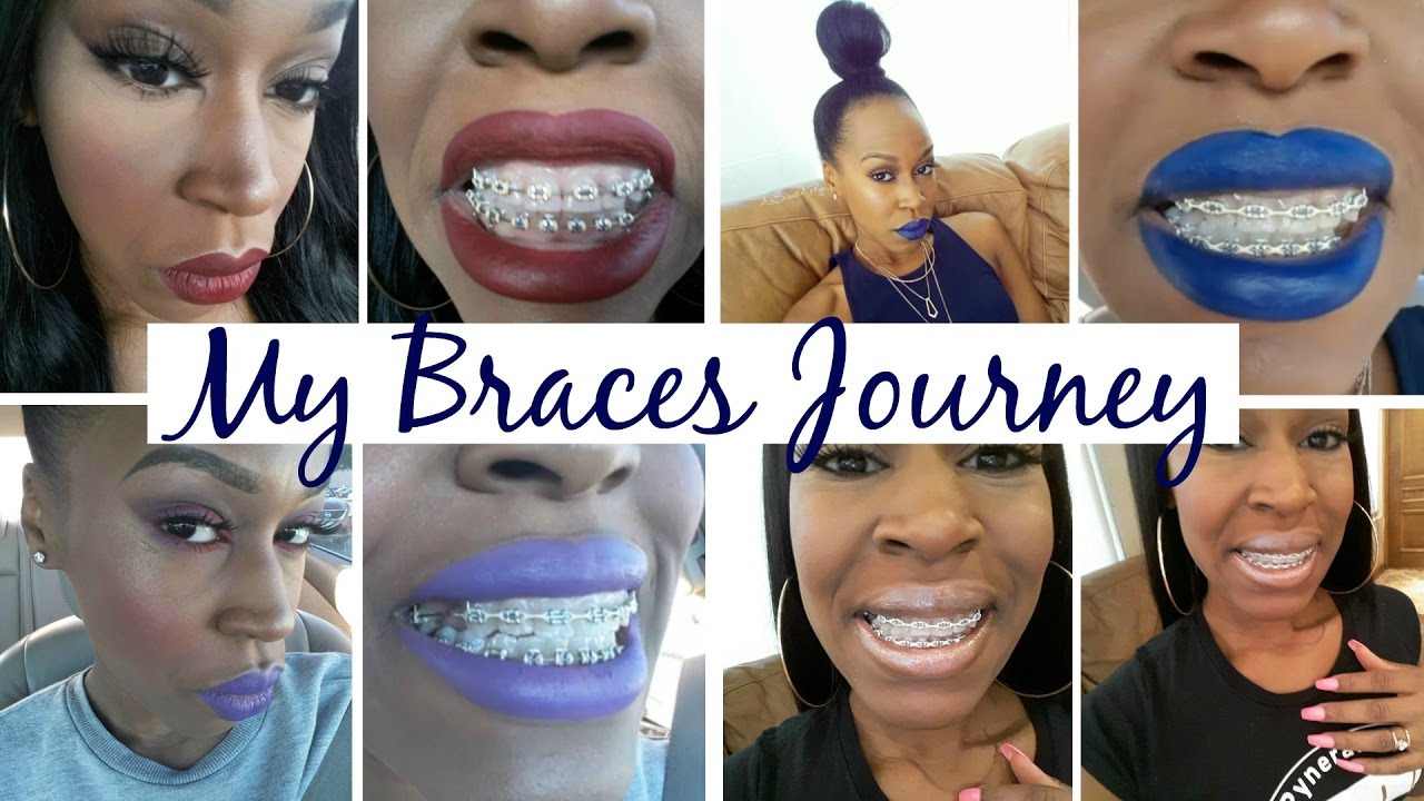 my braces journey