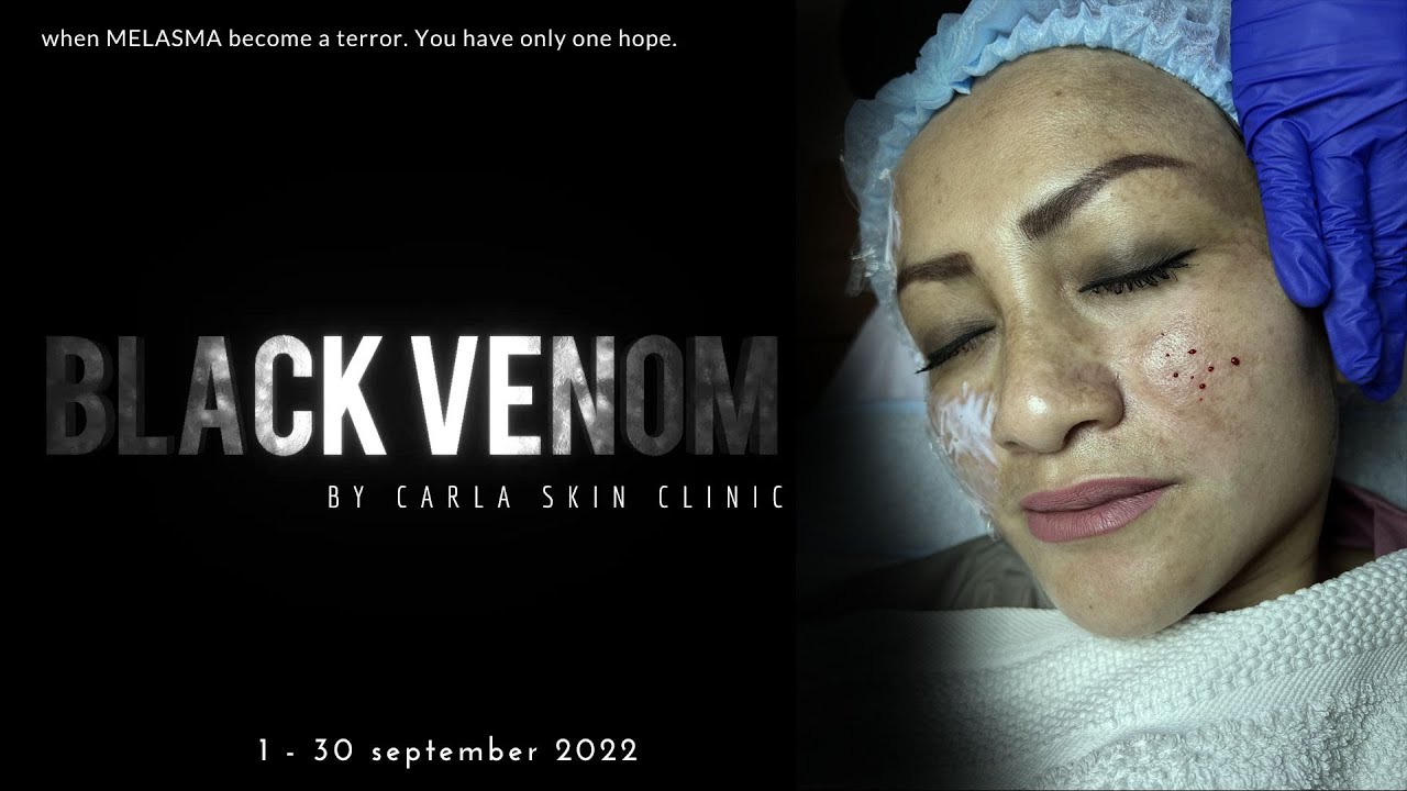 Black Venom. When Melasma Become a Terror. by Carla Skin Clinic.
