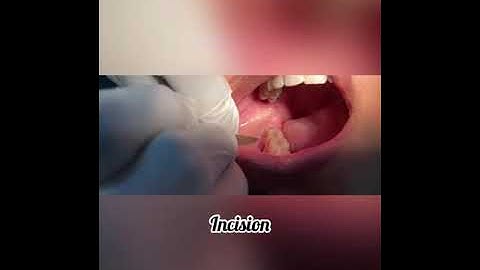 Distoangular Wisdom Tooth Removal