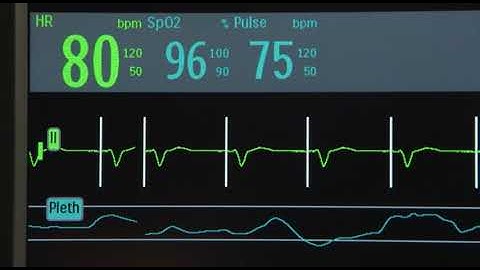 Non-Invasive Transcutaneous Pacing with the Efficia DFM100 monitor/defibrillator