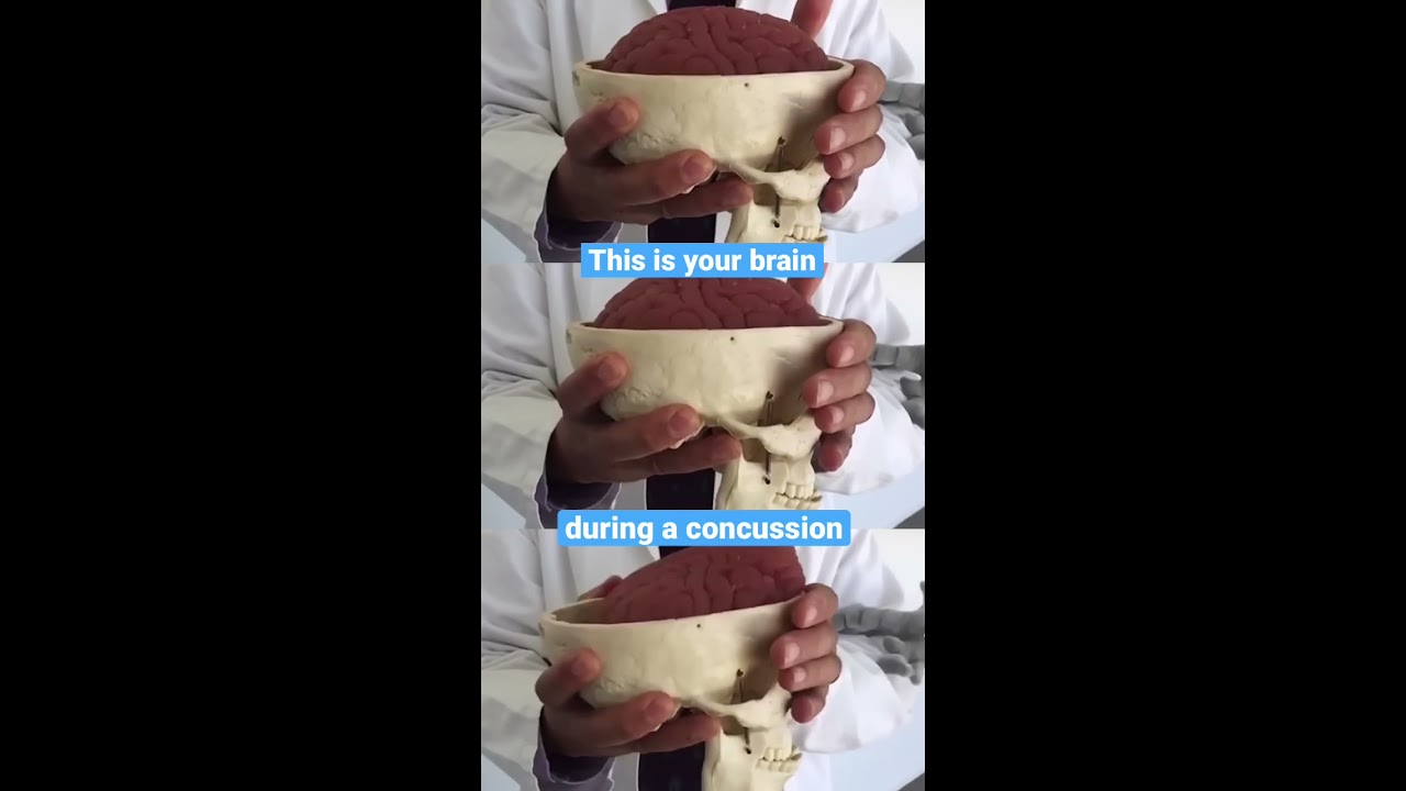 This Is Your Brain During A Concussion 