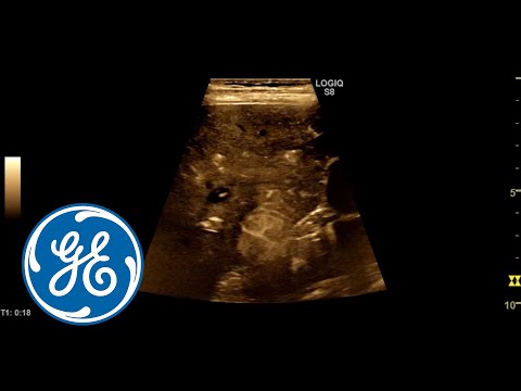 mrid дикий яд ремикс Liver CEUS