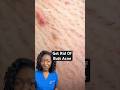 Butt Acne рџЌ Why You Get It How To Get Rid Of It Butt Acne рџЌ Why You Get It How To Get Rid Of It