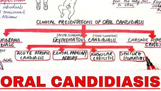 Oral Candidiasis  Causes, Clinical presentations, Treatment
