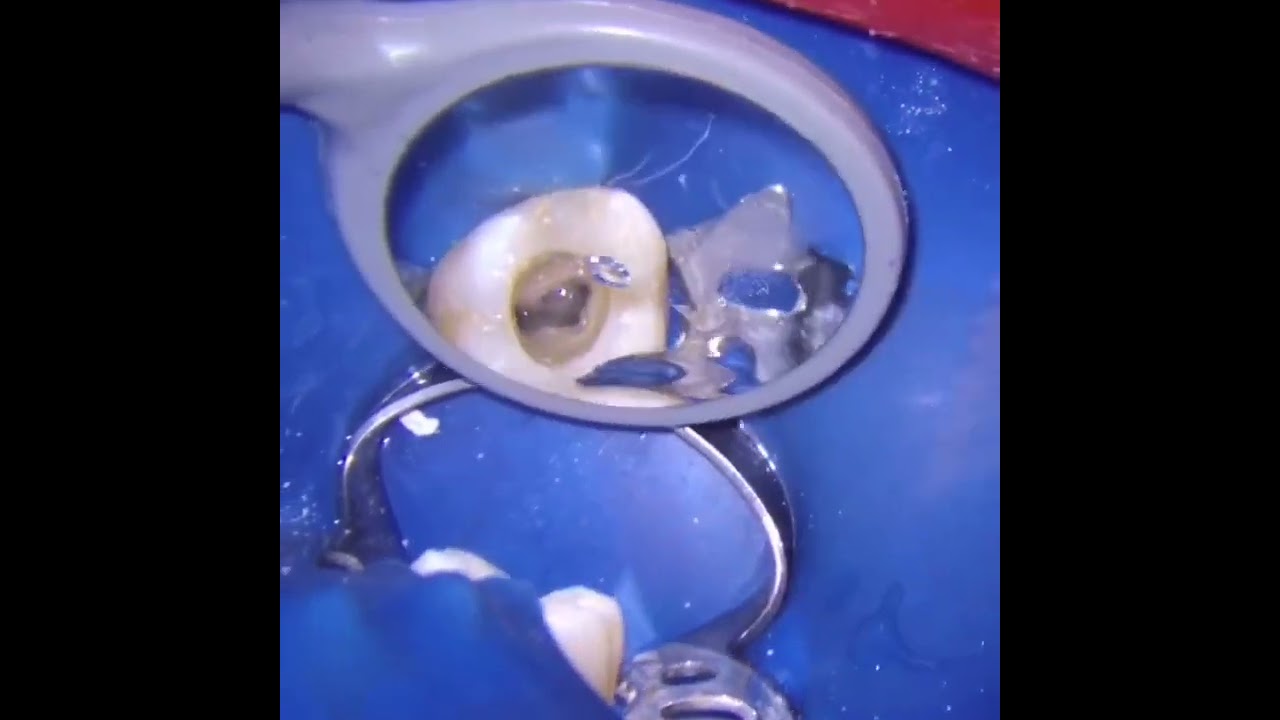 localización, patencia y preparacion del conducto MV2