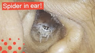 SPIDER CRAWLS OUT OF WOMAN'S EAR