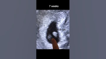 7 Weeks Pregnancy Ultrasound Scan | Wow moment #shorts #drsita #mindbodycare