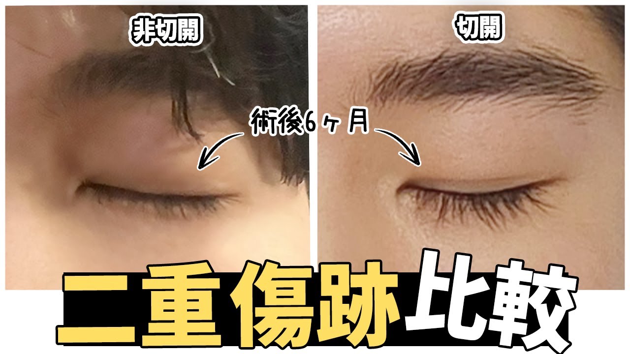#目整形 #二重 #二重の傷跡 #切開二重 #非切開二重 #目つき矯正 #手術前後 #前後比較 #韓国整形
