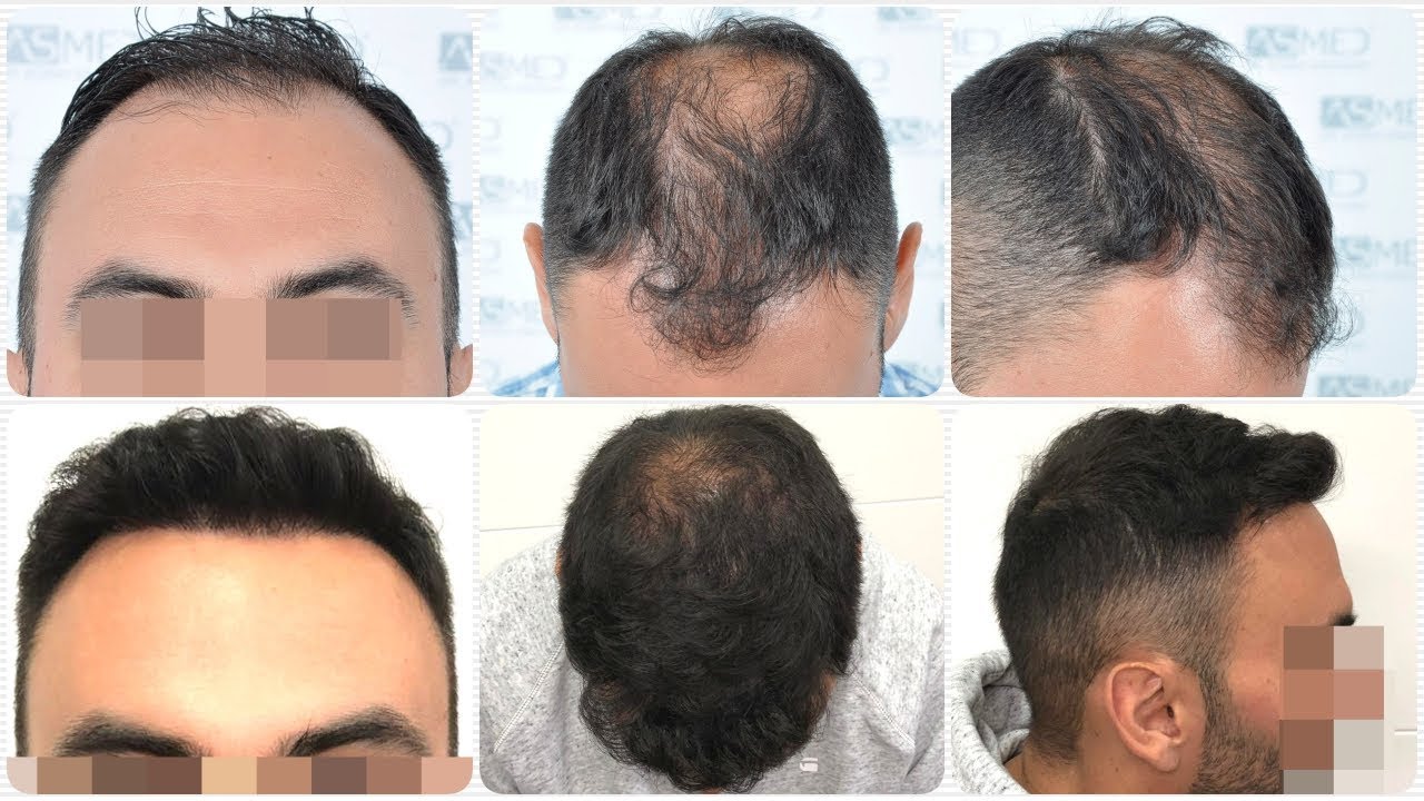 Пересадка волос в новосибирске. Трансплантация волос на лоб. Органическая трансплантация волос.