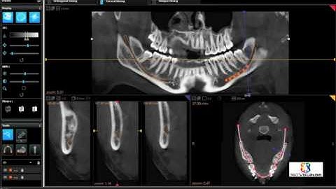 360Visualise 3rd Molar Video