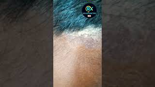 सब स्किन की सभी बीमारियों का सफल ईलाज Khushi Healthcare whats app no 9503575146 viralvideo viral