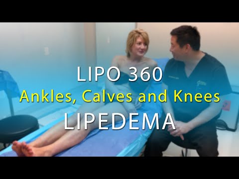 Lipedema Leg Liposuction Surgery Results | Lipo 360° Legs | Cankles & Knees | Expert Dr. Thomas Su