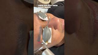 Eyebrow microblading tattoo removal on an African American female at ExcelLase in Raleigh NC.