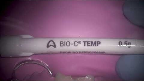 Placement of Bio C temporary intra canal medicament from Angelus