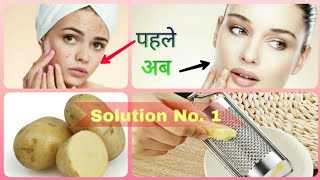 आलू से चेहरे के दाग धब्बे हटाये || Remove Black Heads and Dark Spots | Potato Face Pack