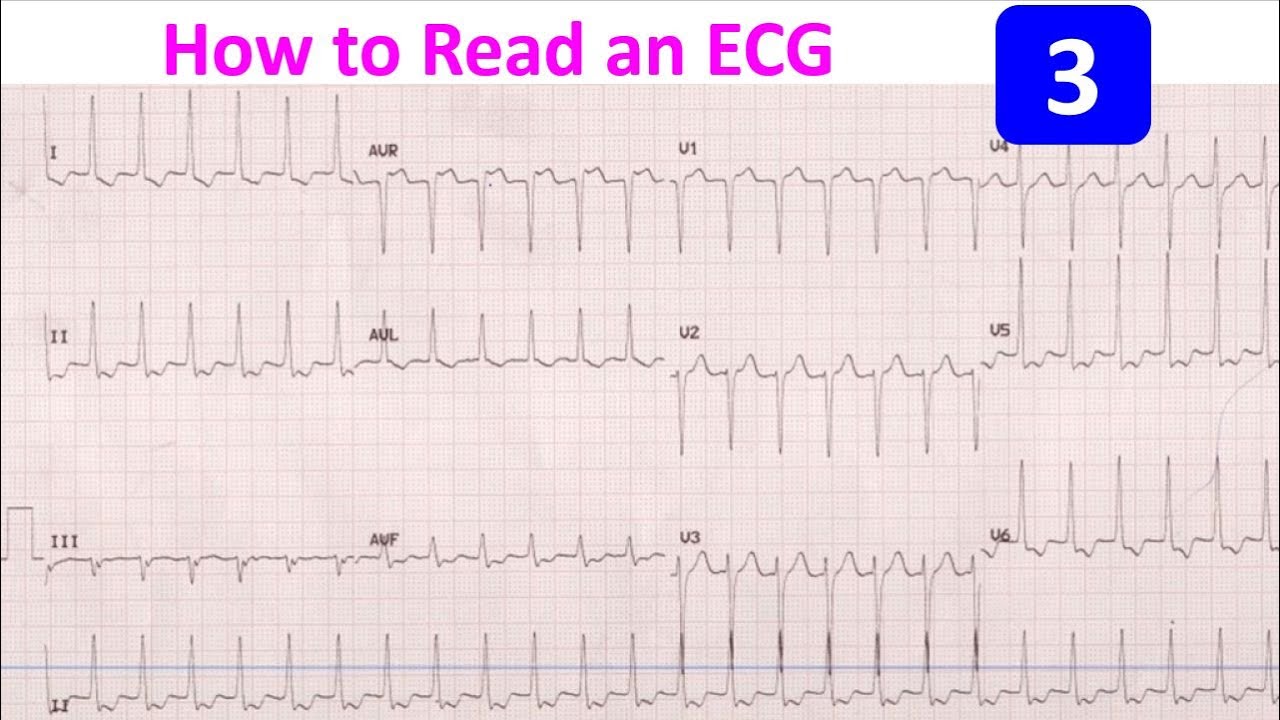 How to Read an ECG - 3 - YouTube