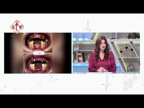 رحلة علاج مريض عمل 8 زرعات أسنان في جلسة واحدة بدون ألم الدكتور أشرف كامل رفعت صحتك