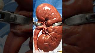 Kidney Transplant Process Kaise Hota Hai? | 3D Medical Animation Hindi #shorts