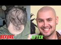 REAL Scalp Micropigmentation Result in Los Angeles, California