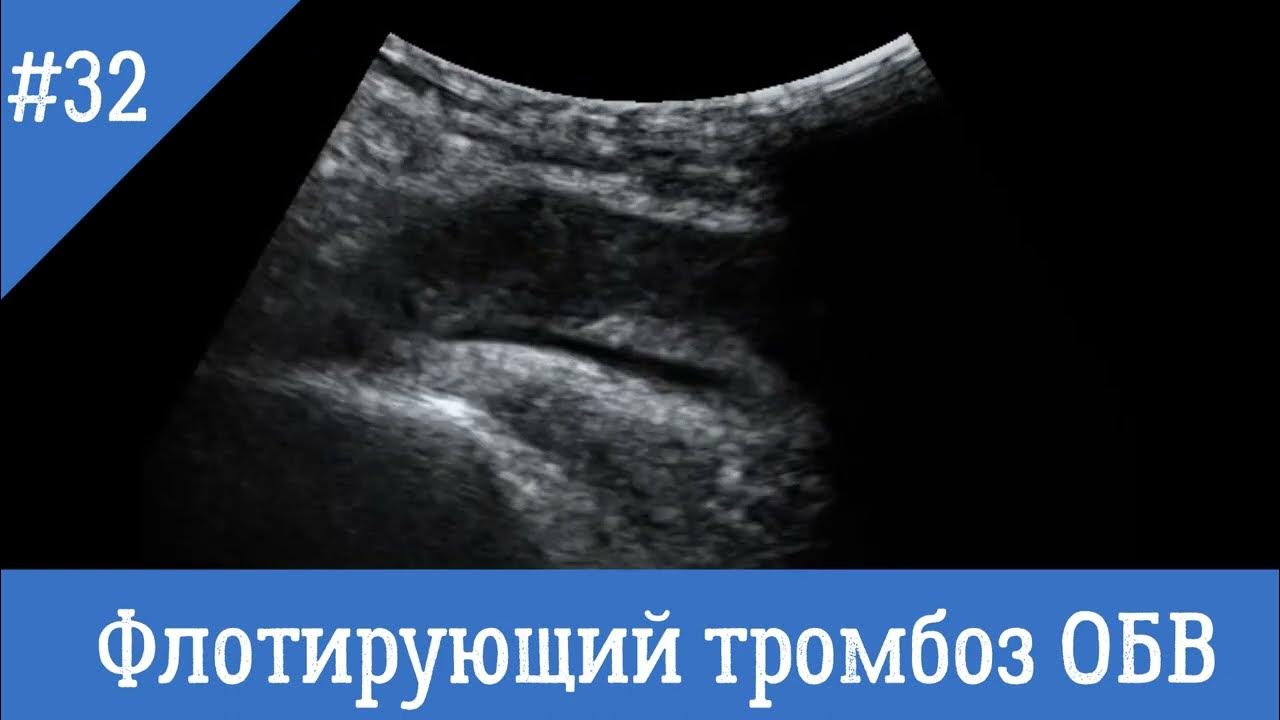 Флотирующий тромб. Флотирующий тромбоз узи.