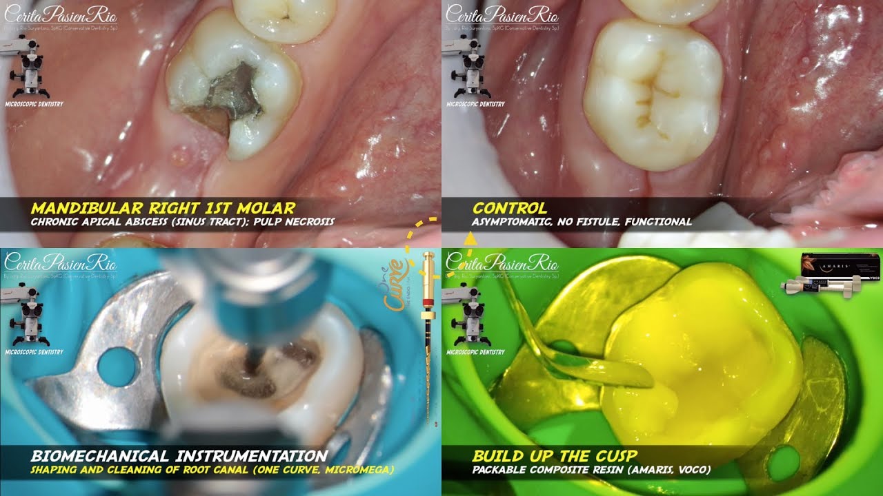 rewalling endodontic bioceramic sealer chronic apical abscess abses