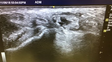 Tibial Nerve Block/Tarsal Tunnel Injection