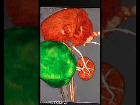 米地のCT読影　腎臓がんの3D像解説