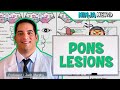 Pons Lesions