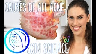 THE 4 CAUSES OF ALL ACNE | Skin Science Episode 5