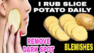 PANTANGGAL NG PEKAS AT DARK SPOT GAMIT ANG PATATAS|SHANELLE SECRETS