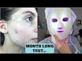 I TRIED AN LED LIGHT THERAPY MASK FOR MY ACNE FOR ONE MONTH || What happened, my thoughts.