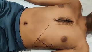 Methods Of Palpation Of Spleen, Dept. Of Medicine, Jnmc