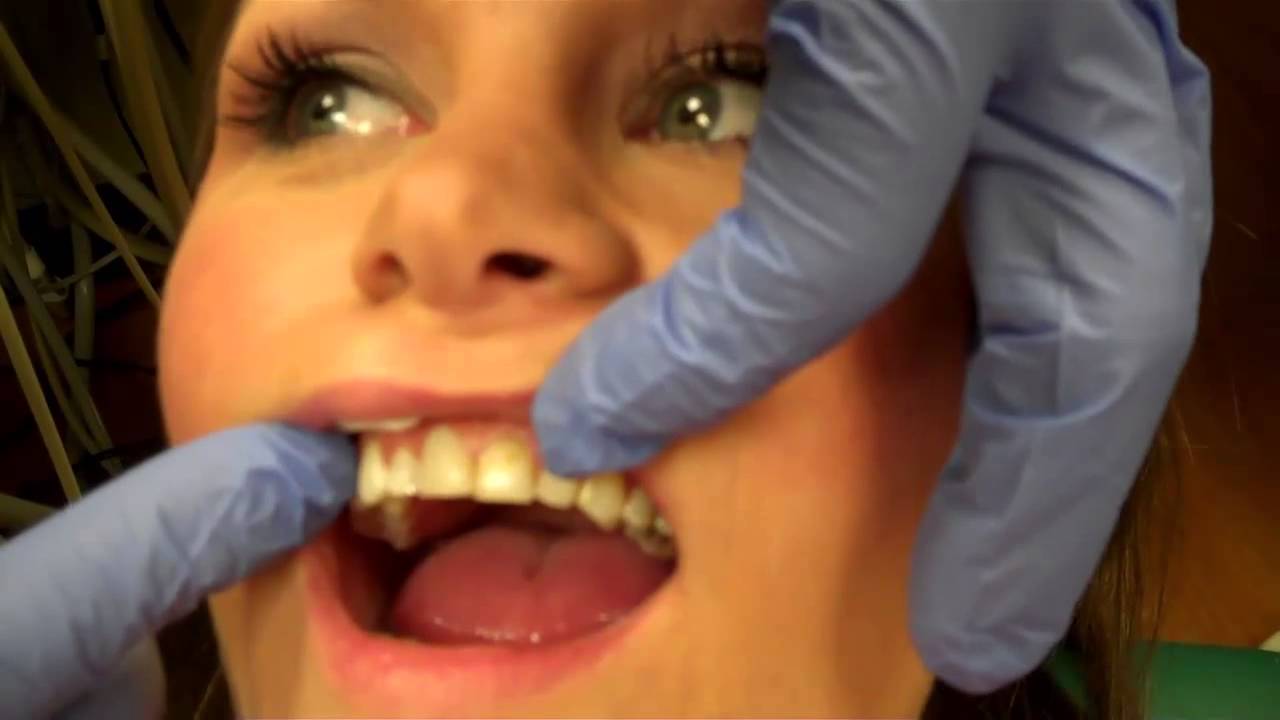 Porcelain veneers in Louisville KY (502) 9692396 YouTube