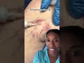 Leg thread vein removal