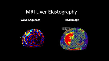 MRI Liver Elastography, Stage 4 Cirrhosis