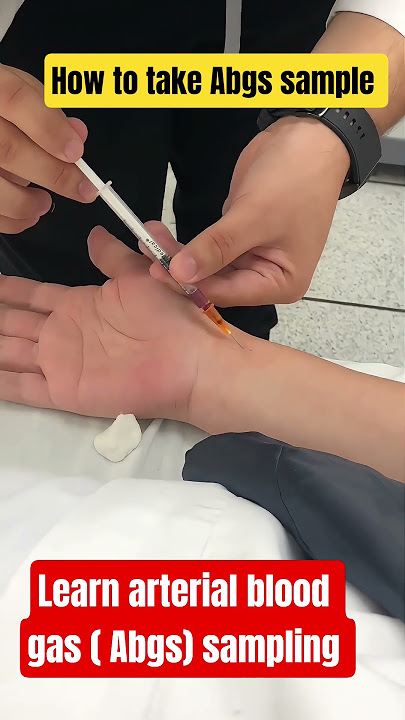 How to get Arterial blood gass sample #abgs #arterial #medical #nursing #usmle #plab2