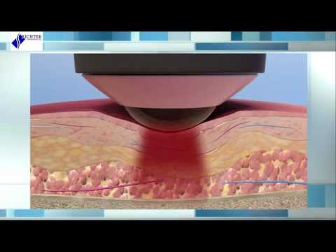 Deep Tissue Laser Therapy- The Science Behind Healing