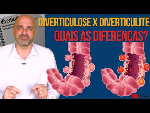 Vídeo: A diverticulite é do lado direito?